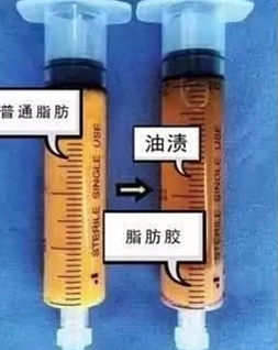 自体脂肪胶