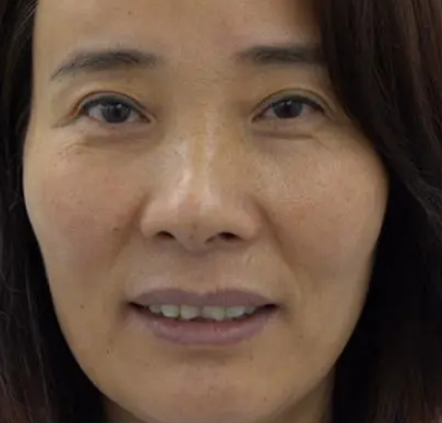 自体脂肪胶