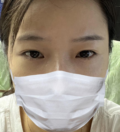 自体脂肪胶
