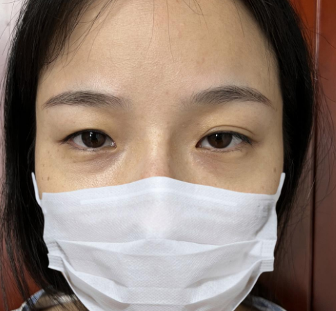 自体脂肪胶