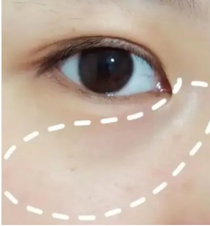 自体脂肪胶