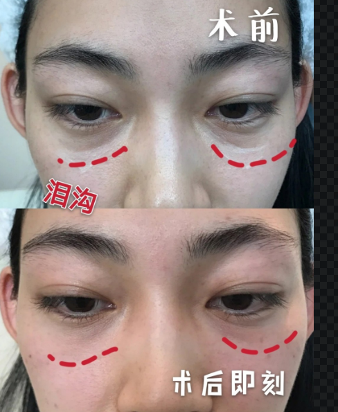 自体脂肪胶