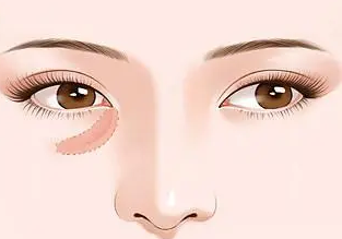 自体脂肪胶