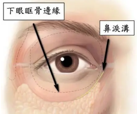 自体脂肪胶