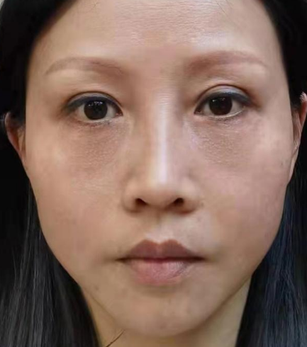 自体脂肪胶