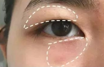 自体脂肪胶