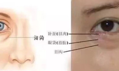 自体脂肪胶