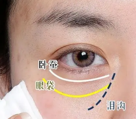 自体脂肪胶