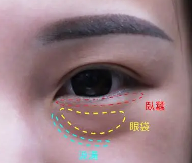 自体脂肪胶