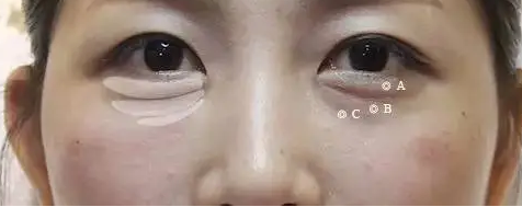 自体脂肪胶