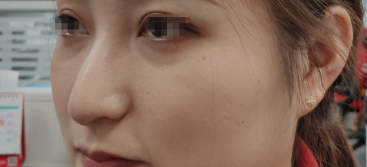 自体脂肪胶