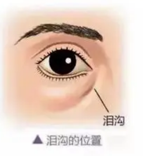 泪沟填充