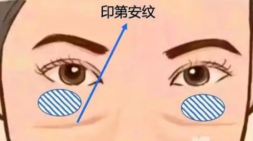 泪沟填充
