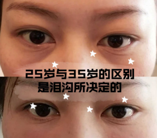 泪沟填充
