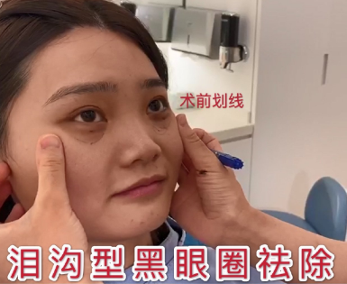 泪沟填充