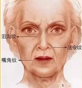 泪沟填充