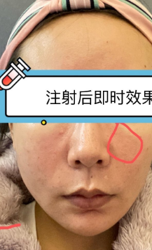 泪沟填充