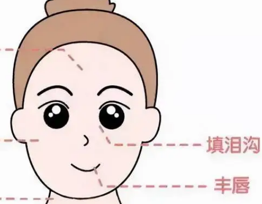 泪沟填充