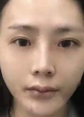 自体脂肪胶