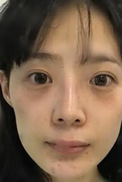 自体脂肪胶