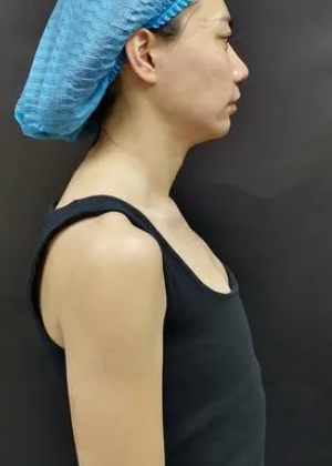 自体脂肪丰胸