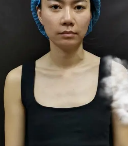自体脂肪丰胸