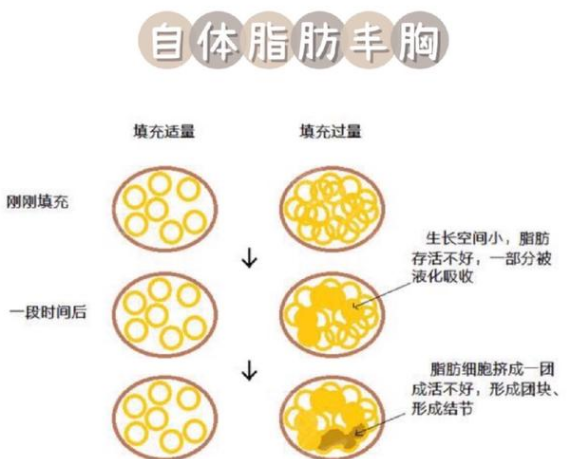 自体脂肪丰胸