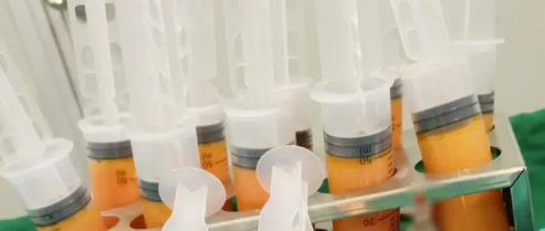 自体脂肪丰胸