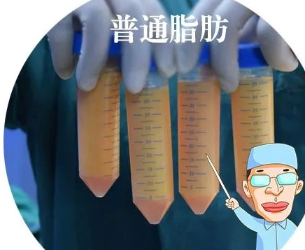 自体脂肪丰胸
