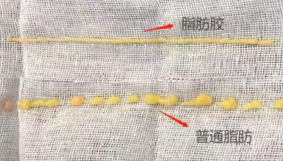 自体脂肪丰胸