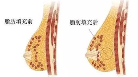 自体脂肪丰胸
