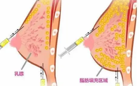 自体脂肪丰胸