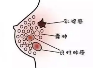 自体脂肪丰胸
