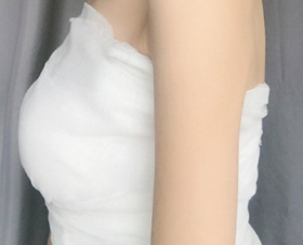 自体脂肪丰胸