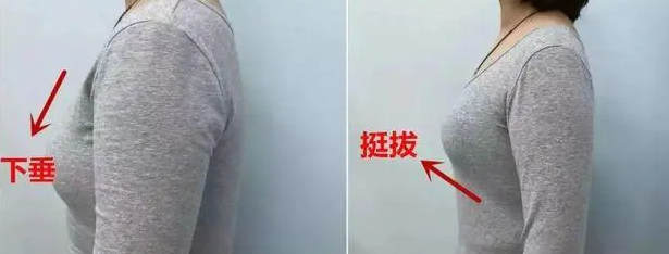 自体脂肪丰胸