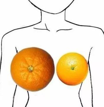 自体脂肪丰胸