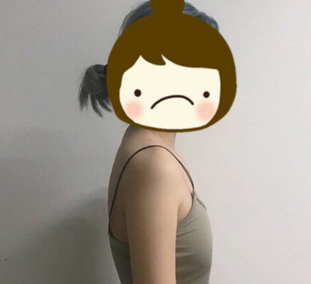 自体脂肪丰胸