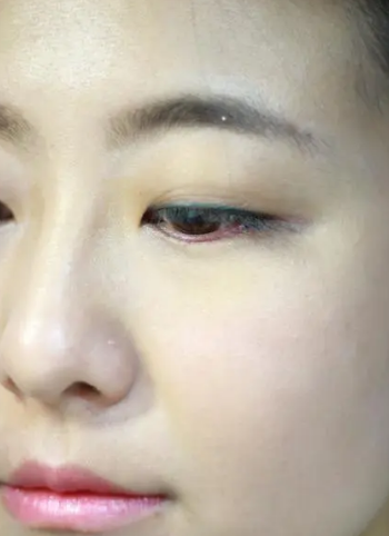 自体脂肪丰胸