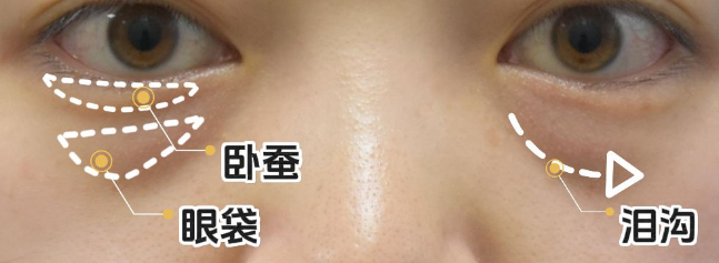 眼袋