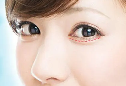 眼袋