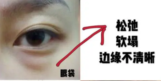 眼袋