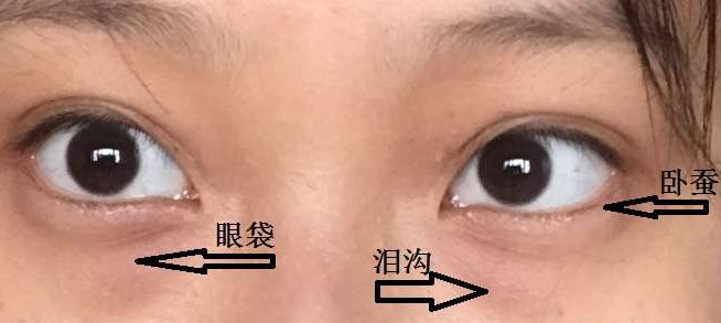眼袋