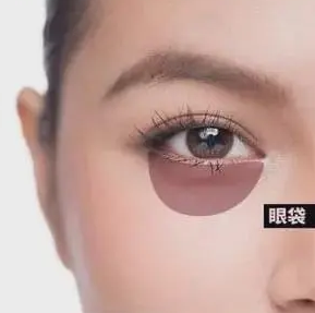 去眼袋手术