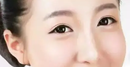 去眼袋手术