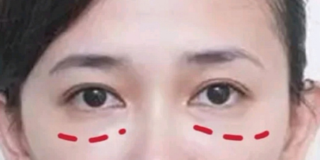 去眼袋手术