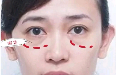 去眼袋手术