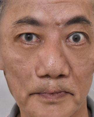 去眼袋手术