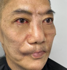 去眼袋手术