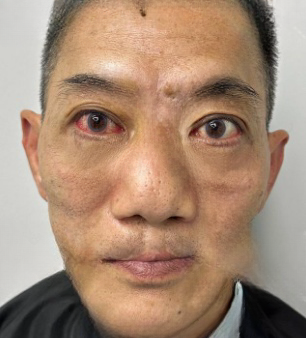 去眼袋手术