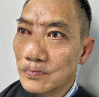 去眼袋手术